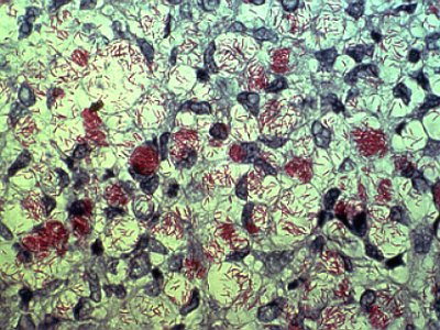 Mycobacterium leprae (zobrazeno pomocí Zeihl-Neelsenova barvení)