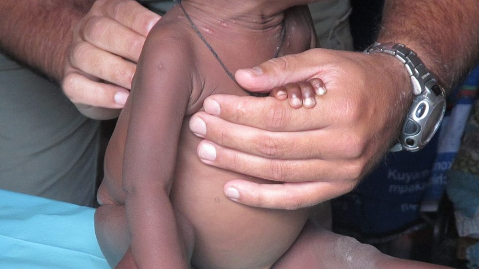 Humanitární mise v Malawi - Vyšetřování podvyživeného miminka