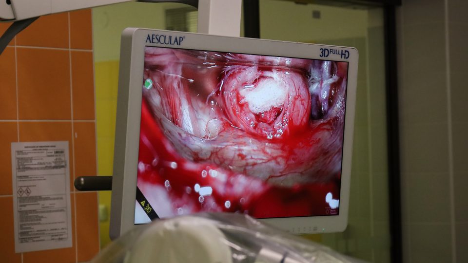 Operatér vidí přímo do vnitřního zvukovodu, kde je ukrytý nádor