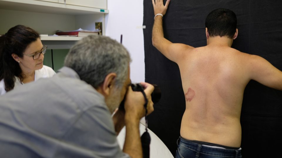 Diagnostická data sbírají vědci fotografováním lézí pacientů nakažených leprou