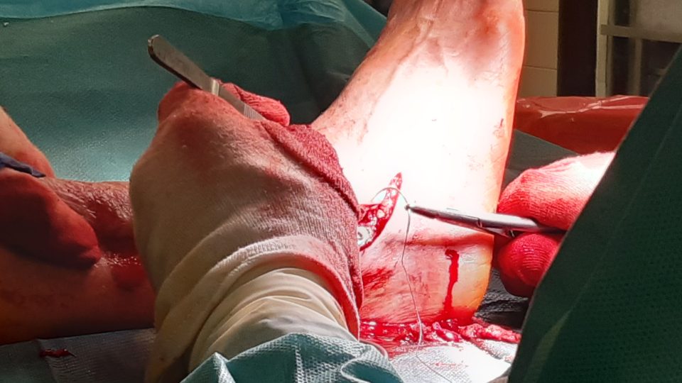 „Po operaci musí být noha stabilní, pevná," zdůrazňuje Stanislav Popelka