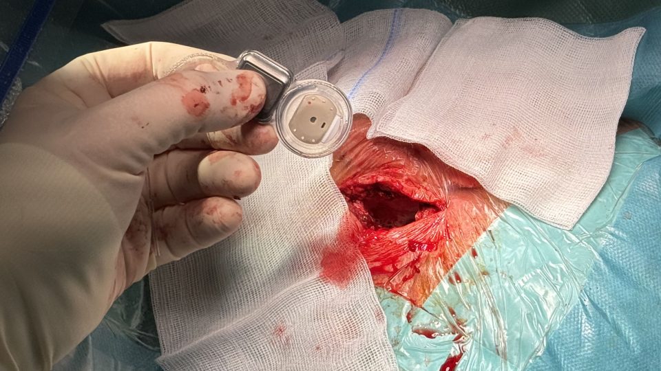 Kochleární implantát je destička o rozměrech několik málo centimetrů