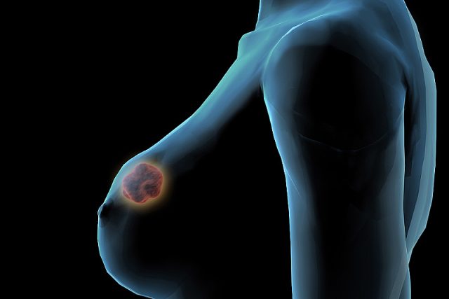 Nová léčivá látka Mito Tam působí proti rakovině prsu,  ale vědci doufají,  že by mohla mít širokospektrální účinky a pomoci i s léčbou jiných typů nádorů. | foto: Fotobanka Profimedia