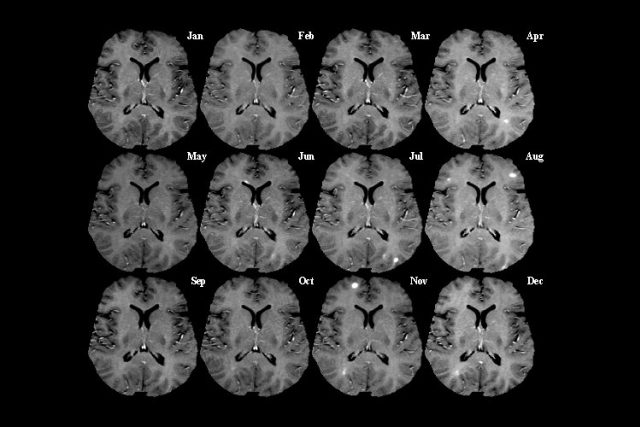 Snímky řezu mozku z magnetické rezonance v měsíčních intervalech. Světlé skvrny indikují aktivní poškození  (léze) | foto:  public domain,   Brookhaven National Laboratory