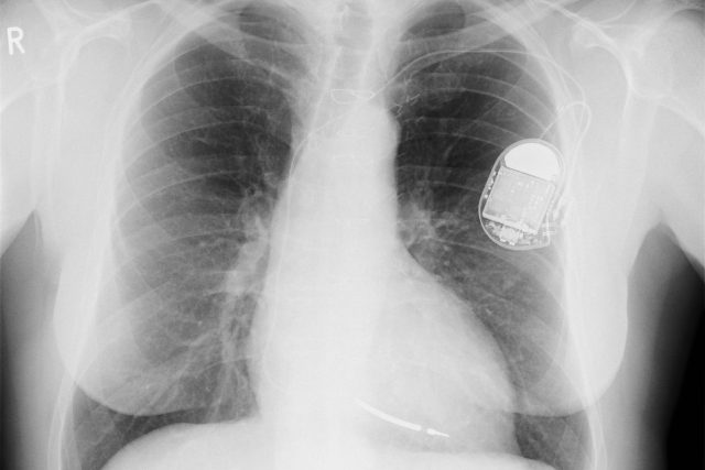Rentgenový snímek hrudníku s implantovaným kardiostimulátorem | foto: licence Creative Commons Attribution 3.0 Unported,   Sunzi99
