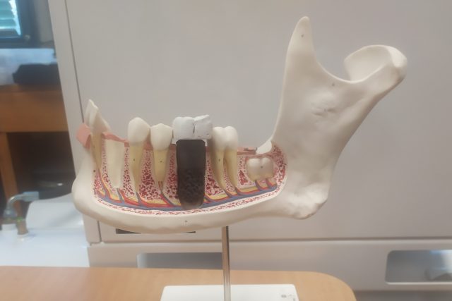 Malý kovový váleček je v podstatě umělý zubní kořen | foto: Tereza Janouškovcová Bartůňková,  Český rozhlas