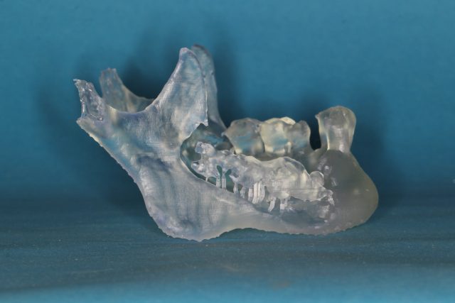 Model čelisti vyrobený 3D tiskárnou. Jedná se o pacienta s těžkým zánětlivým postižením čelisti | foto: 1. lékařská fakulta Univerzity Karlovy