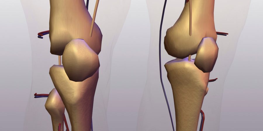 jak na artrózu boli traumatice ale genunchiului